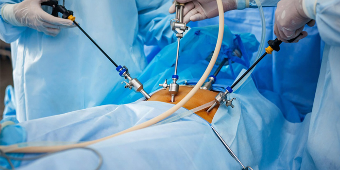 ventajas de una Cirugía Laparoscópica